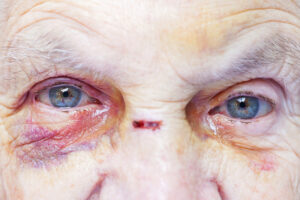 Primer plano del ojo y la cara lesionados de una anciana